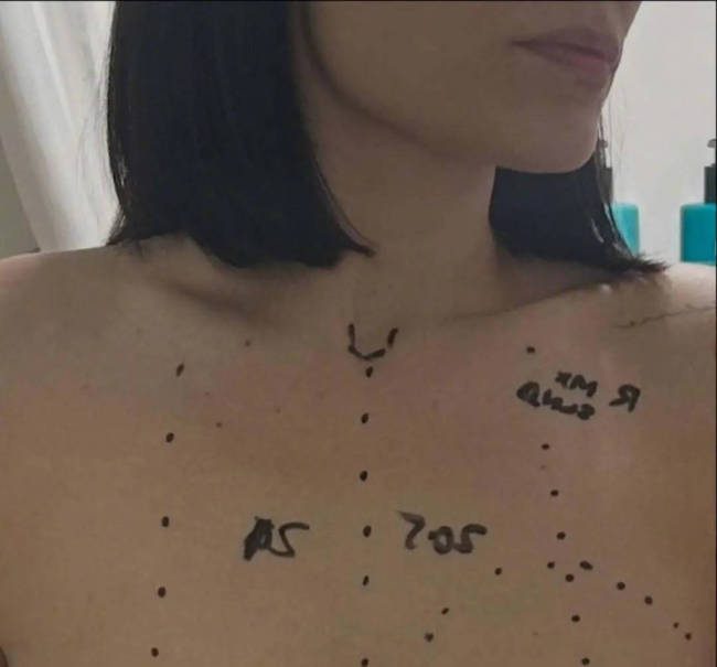 结石姐分享乳腺癌手术照片 躺在病床上满脸憔悴